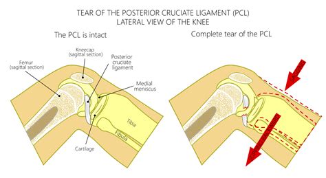 pcl tear moi